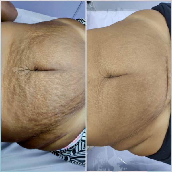 Tratamento Com Microagulhamento para Estrias.