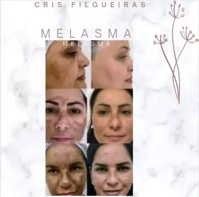 Melasma